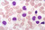 Hairy cell leukemia_tiny